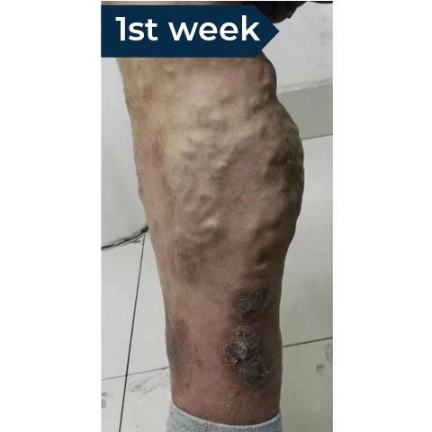 Therapeutic Laser for the Treatment of Varicose Veins